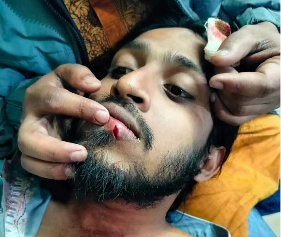 ইনকিলাব মঞ্চের কর্মসূচিতে পুলিশের হামলা,  গুরুতর আহত রাকসু জিএস