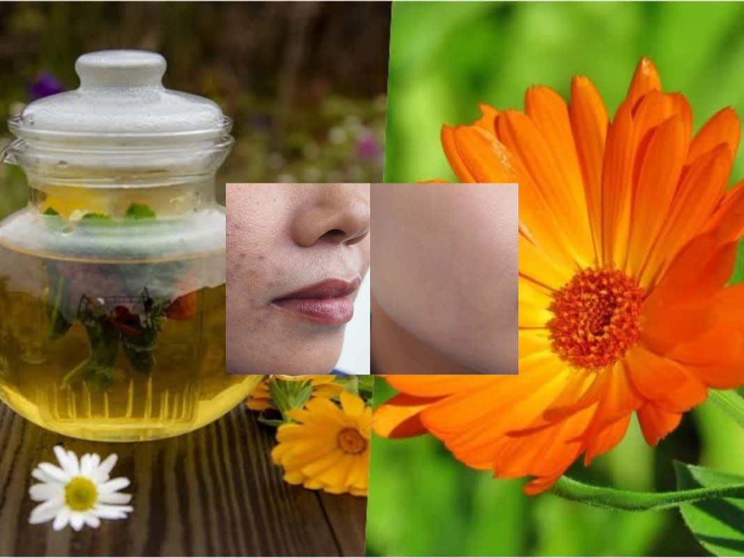 ব্রণ ও দাগ দূর করবে ক্যালেন্ডুলা - ত্বকের সুরক্ষায় বিশেষ ব্যবহার