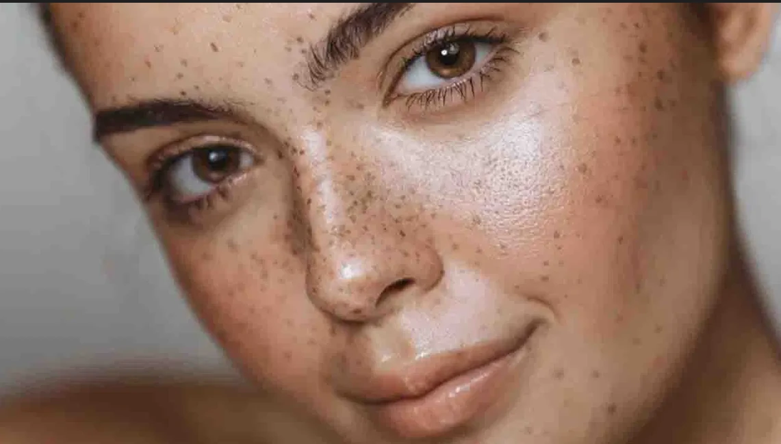 ত্বকের দাগ আত্মবিশ্বাস কমাচ্ছে?হাইপারপিগমেন্টেশনের কারণ, প্রতিকার ও সতর্কতা!