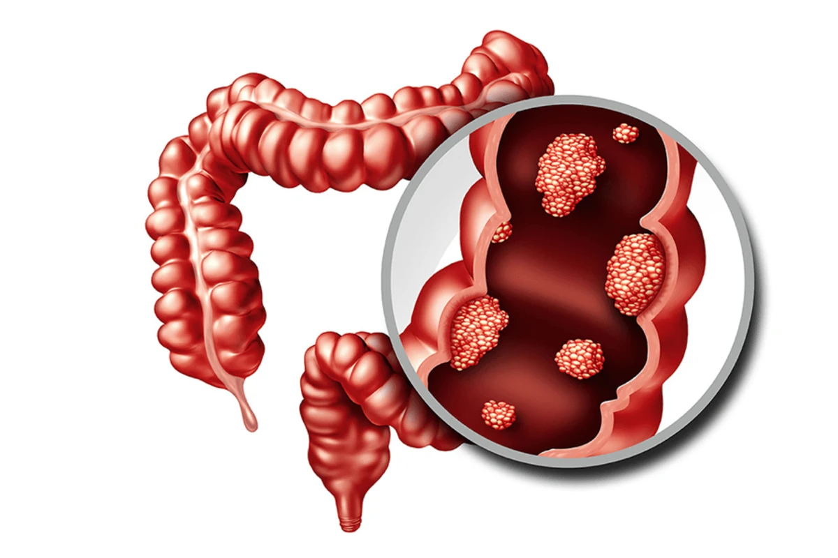 তরুণদের মধ্যে বাড়ছে রেক্টাল ক্যানসার! লক্ষণ শুরুতেই চিনুন, সতর্ক থাকুন এখনই!