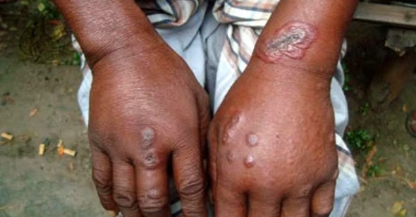 রংপুরে আরও নয়জনের শরীরে অ্যানথ্রাক্স-সদৃশ উপসর্গ শনাক্ত