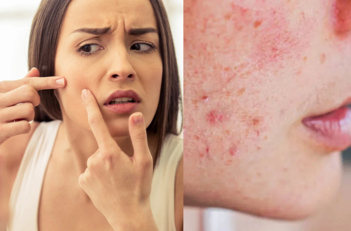 ব্রণ? আর নয় ভয়! জানুন ত্বক ফর্সা ও ব্রণমুক্ত হওয়ার অপ্রতিরোধ্য উপায়!