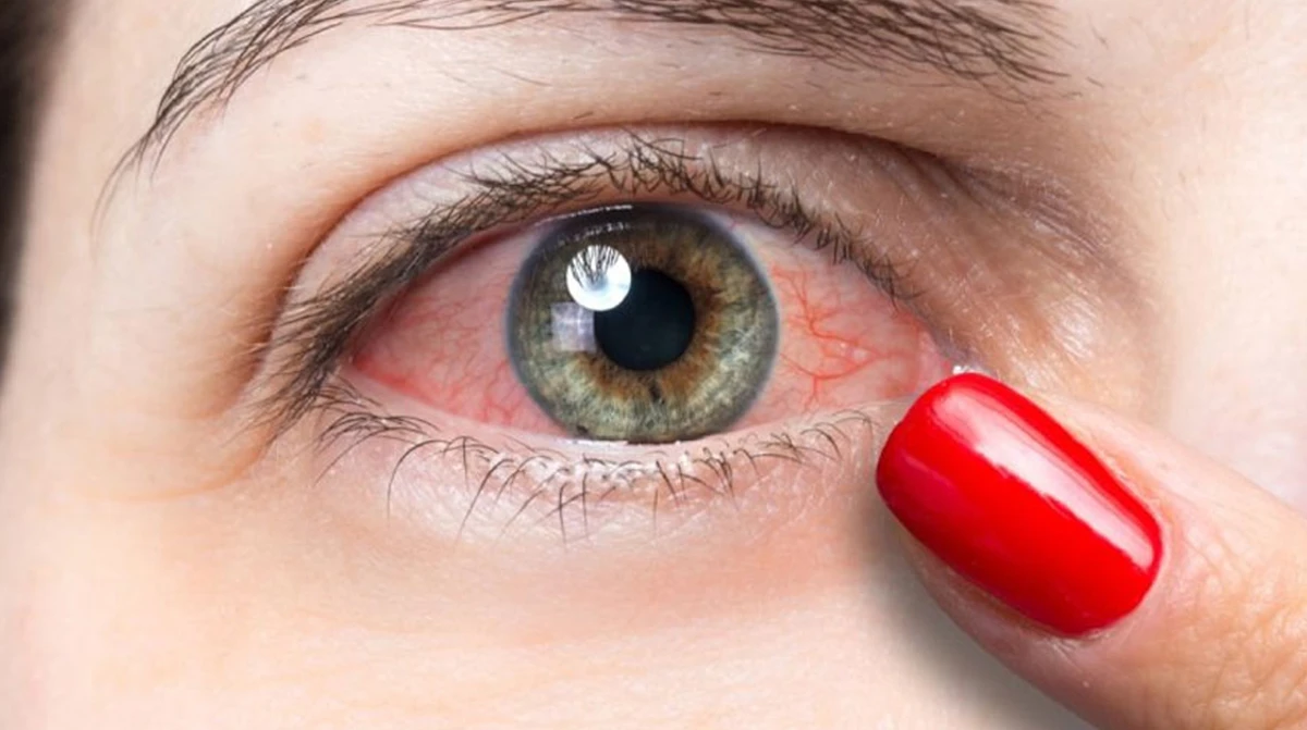 চোখে জ্বালা অনুভূত হলে সতর্ক হোন এক্ষুনি, হতে পারে বড় ঝুঁকির ইঙ্গিত!