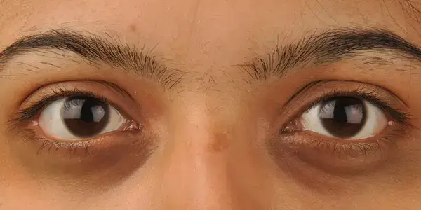 ডার্ক সার্কেল কি শুধু ঘুমের ঘাটতির ফল? জানুন  আসল কারণ ও সমাধান
