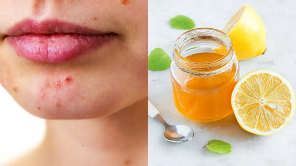 স্কার কমানোর সহজ পথ?লেবুর রসের অদ্ভুত কার্যকারিতা নিয়ে নতুন আলোচনায় তোলপাড়!