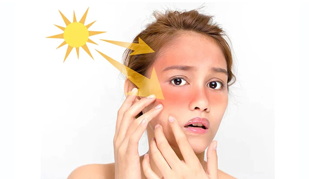 সানবার্ন কীভাবে তৈরি হয়, শরীরে কী ঘটে, এবং কীভাবে নিজেকে রক্ষা করা যায়!