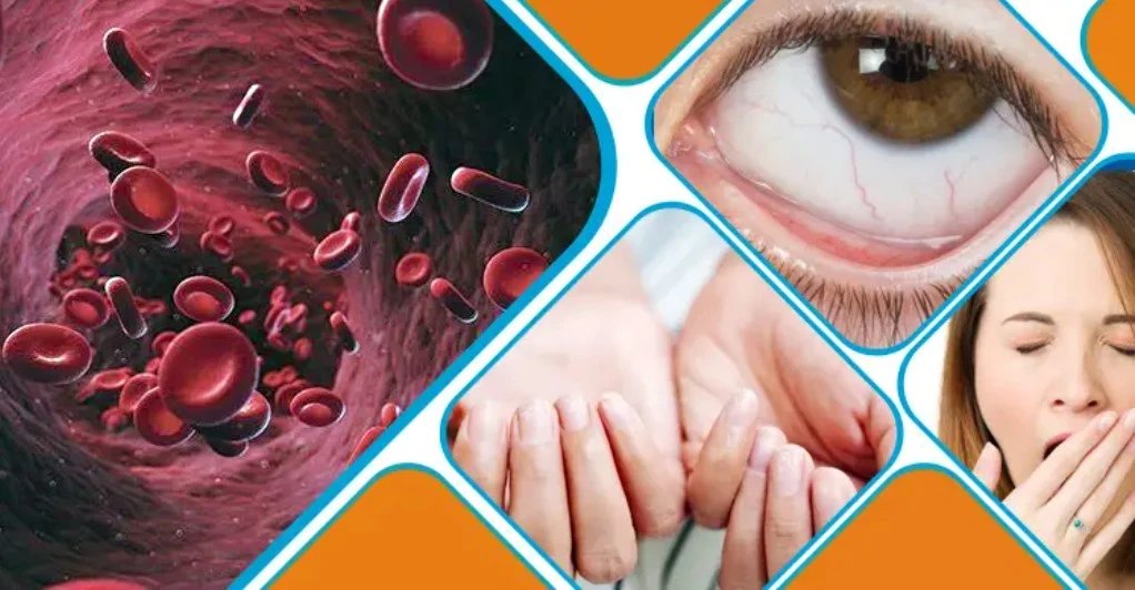 আপনার রক্তশূন্যতা হলে কীভাবে বুঝবেন