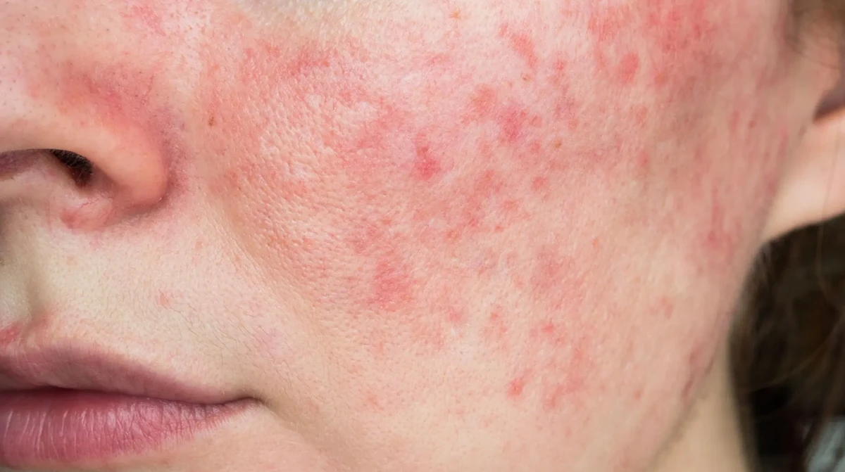 ত্বকের প্রদাহে রাসায়নিক নয়, প্রকৃতিই হতে পারে চিকিৎসা