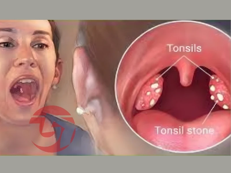 এই ক্ষুদ্র দলা কেন গলায় আটকে বড় সমস্যা তৈরি করে? টনসিল স্টোনের নেপথ্যের সত্য নিয়ে আলোড়ন !