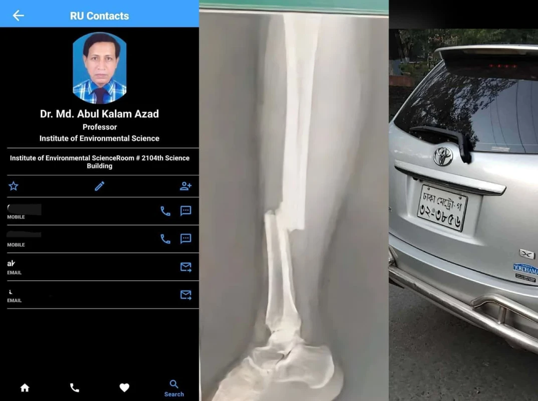 রাবি শিক্ষকের গাড়ির ধাক্কায় পা ভাঙল ছাত্রীর